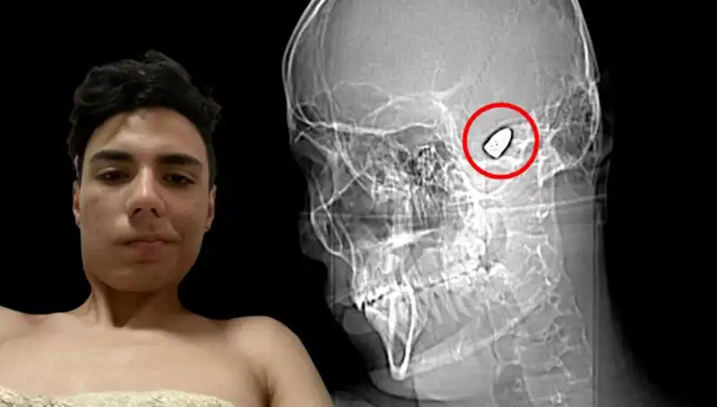 Kafasında Patlamaya Hazır Bomba Taşıyan Adamın Şaşırtan Hikayesi